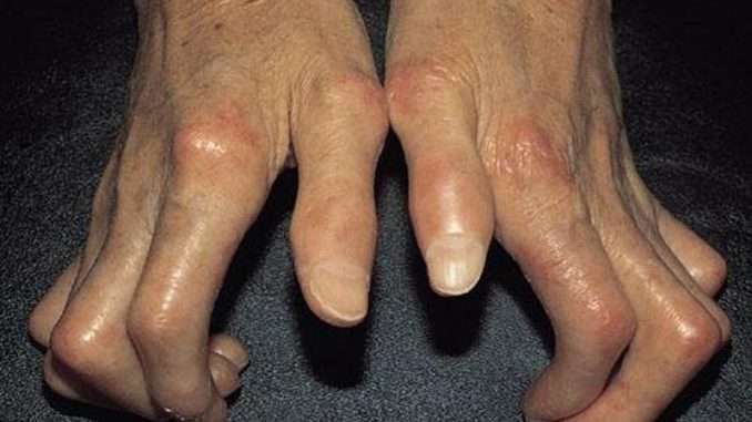 What is Sclerodactyly