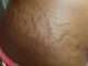 What are stretch marks? causes, prevention.