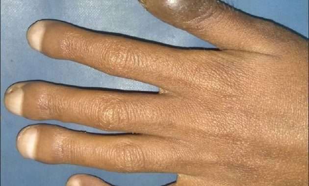What is finger clubbing?