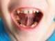 What are dental cavities?