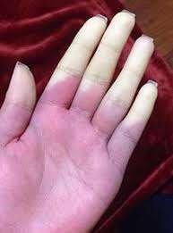 What is Raynaud's?