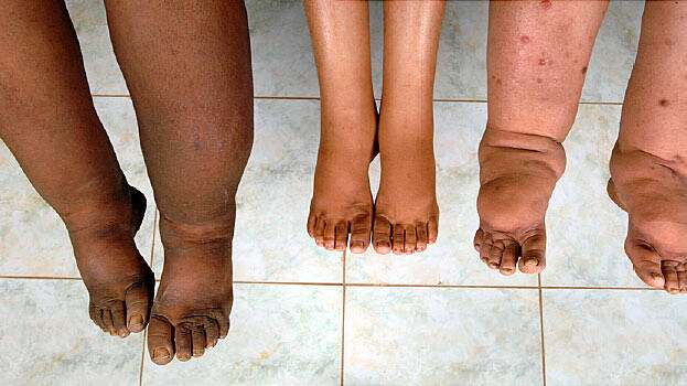 What is lymphedema?