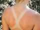 What is sunburn? symptoms and prevention