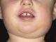 Mumps in a child