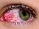 pink eye infection