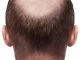 How to grow hair n a bald head