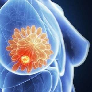 What are breast lumps, Types, symptoms and treatment