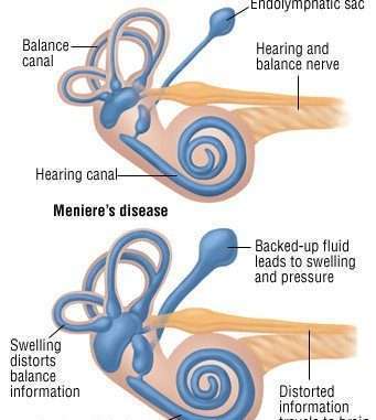 Meniere's disease, causes, symptoms and treatment