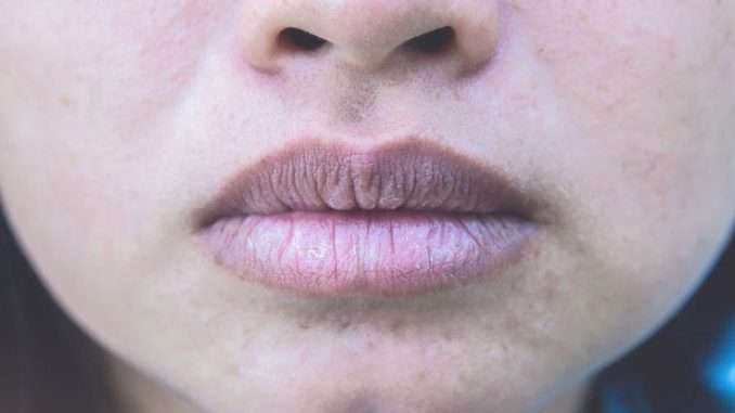 How to treat pale chapped lips