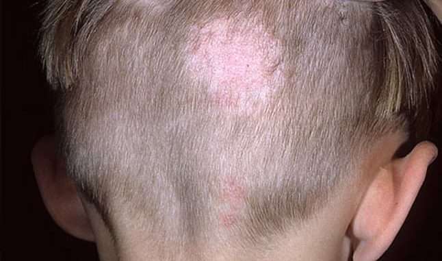 Ringworm on scalp