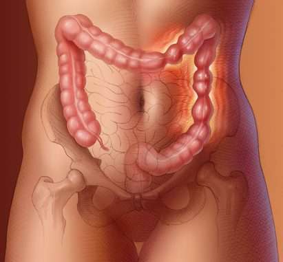 What is Irritable bowel syndrome?