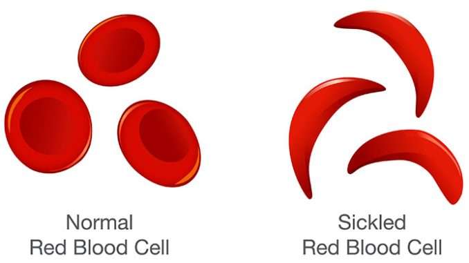 Normal and sicked redcells