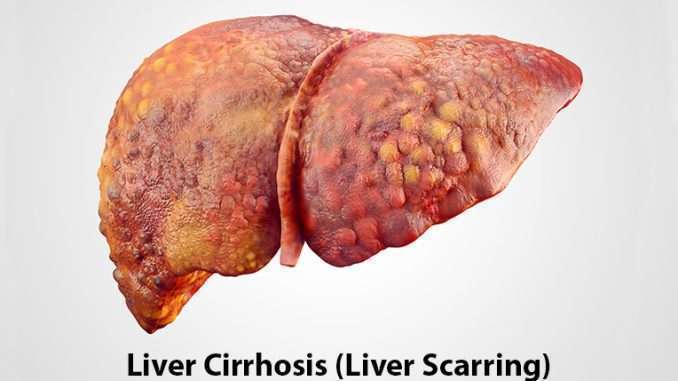 What is Liver Cirrhosis?