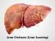 liver affected by cirrhosis