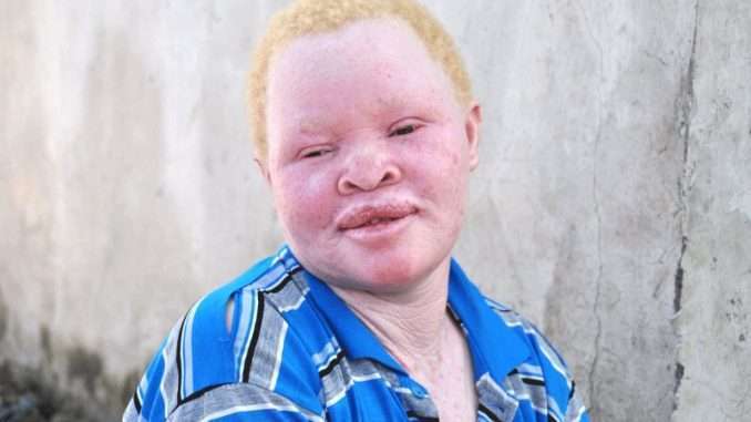 What is albinism?
