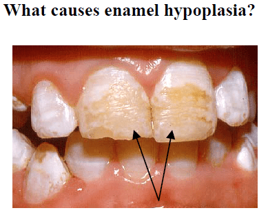 Enamel Hypoplasia