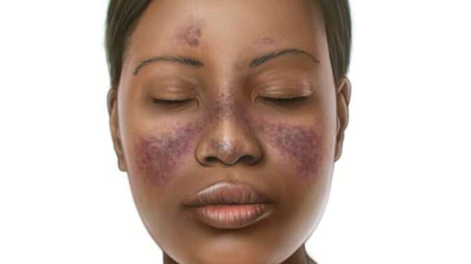 Heard of Lupus? symptoms and treatment.