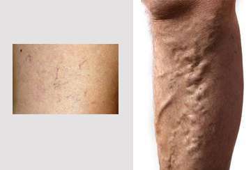 How to eliminate spider and varicose veins.