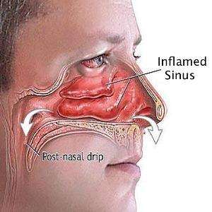 Inflamed sinus infection