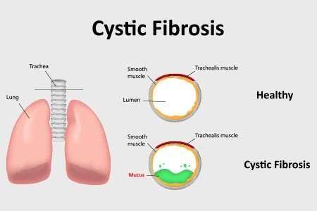 Cystic Fibrosis image