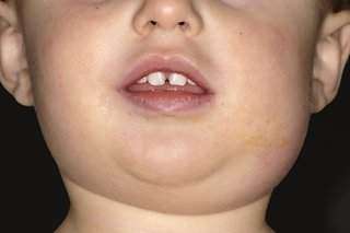 Mumps in a child