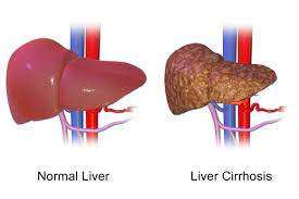 Viral hepatitis liver effects