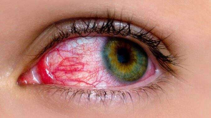 pink eye infection