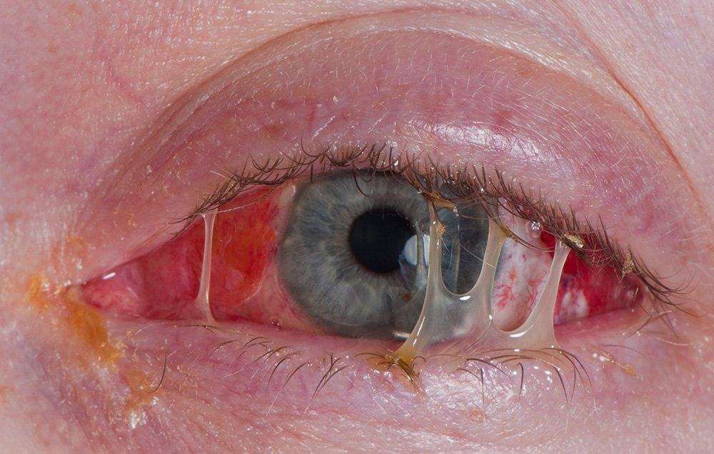 pink eye infection image