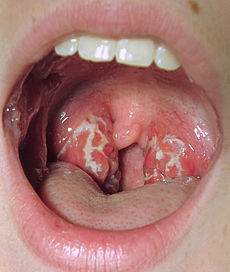 Streptococcal in the mouth