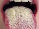 Oral candidiasis jpg