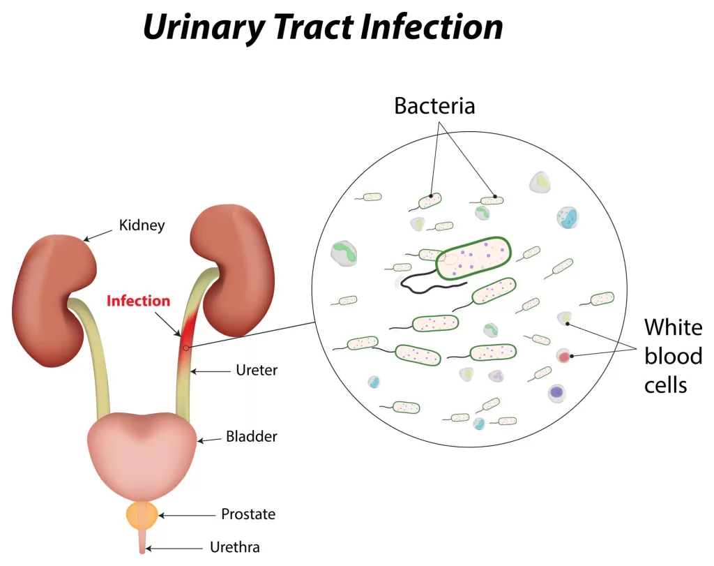 Urinary Tract Infection image