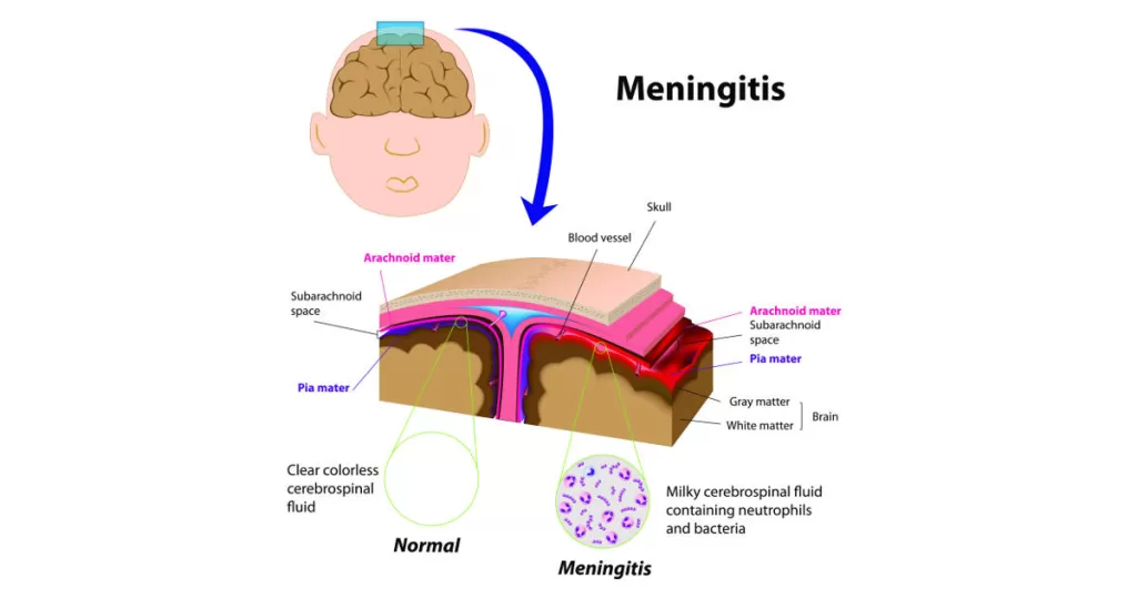 Meningitis infection