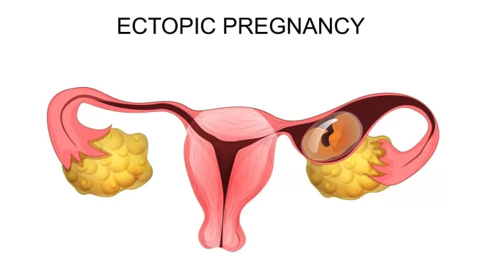 Ectopic pregnancy image jpeg