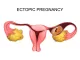Ectopic pregnancy image