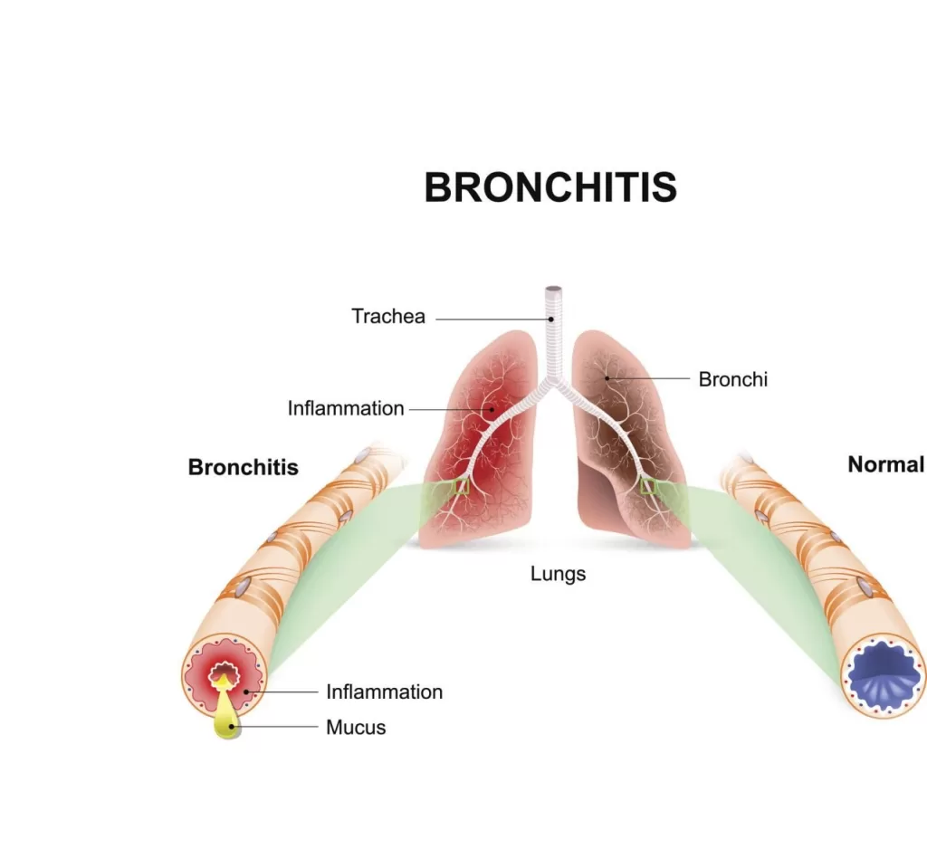 Bronchiolitis image