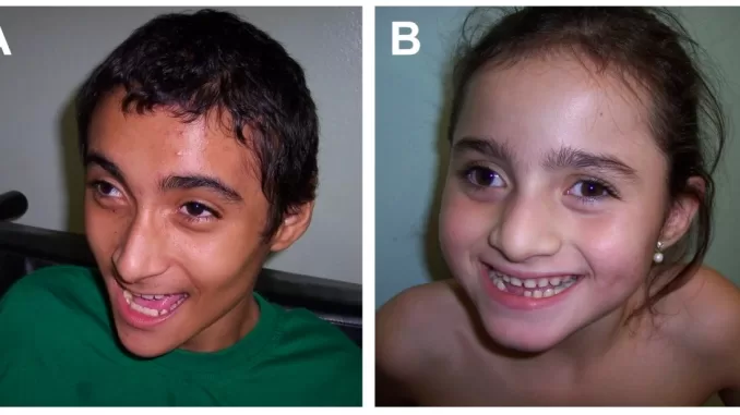 Angelman syndrome in children jpg