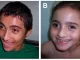 Angelman syndrome in children jpg